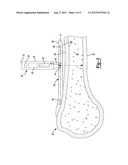 Method and Apparatus for Aligning Bone Screw Holes diagram and image