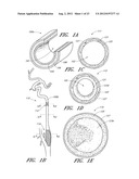 VASCULAR PLAQUE REMOVAL SYSTEMS, DEVICES, AND METHODS diagram and image