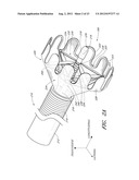 VASCULAR PLAQUE REMOVAL SYSTEMS, DEVICES, AND METHODS diagram and image