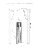 VASCULAR PLAQUE REMOVAL SYSTEMS, DEVICES, AND METHODS diagram and image