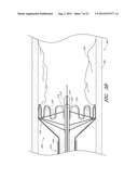 VASCULAR PLAQUE REMOVAL SYSTEMS, DEVICES, AND METHODS diagram and image