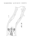 VASCULAR PLAQUE REMOVAL SYSTEMS, DEVICES, AND METHODS diagram and image