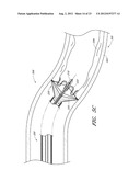 VASCULAR PLAQUE REMOVAL SYSTEMS, DEVICES, AND METHODS diagram and image