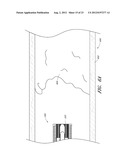 VASCULAR PLAQUE REMOVAL SYSTEMS, DEVICES, AND METHODS diagram and image