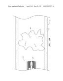 VASCULAR PLAQUE REMOVAL SYSTEMS, DEVICES, AND METHODS diagram and image