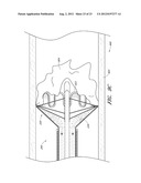 VASCULAR PLAQUE REMOVAL SYSTEMS, DEVICES, AND METHODS diagram and image