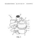 SPINE SURGERY METHOD AND IMPLANT DEPLOYMENT diagram and image