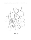 SPINE SURGERY METHOD AND IMPLANT DEPLOYMENT diagram and image