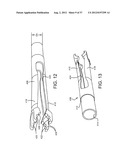 SPINE SURGERY METHOD AND IMPLANT DEPLOYMENT diagram and image