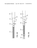 SPINE SURGERY METHOD AND IMPLANT DEPLOYMENT diagram and image