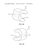 SPINE SURGERY METHOD AND IMPLANT DEPLOYMENT diagram and image