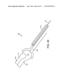 SPINE SURGERY METHOD AND IMPLANT DEPLOYMENT diagram and image