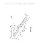 SPINE SURGERY METHOD AND IMPLANT DEPLOYMENT diagram and image