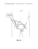 BILATERAL ELECTRICAL STIMULATION THERAPY FOR BLADDER DYSFUNCTION diagram and image