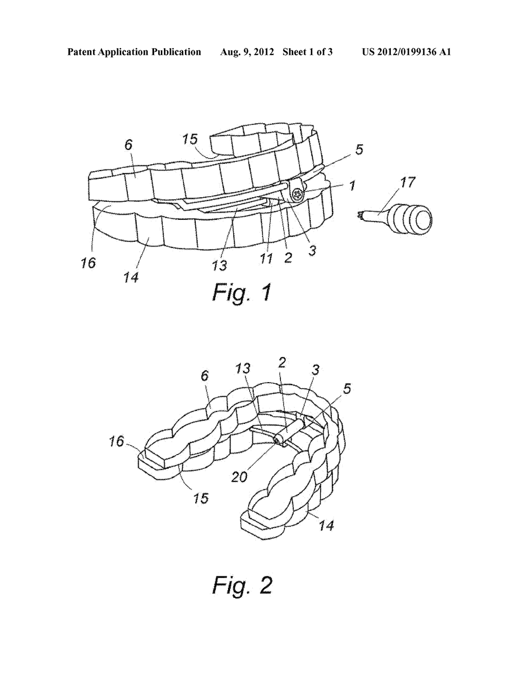 Regulatable Intraoral Mandibular Advancement Device, for Preventing     Snoring and Sleep Apnoea - diagram, schematic, and image 02