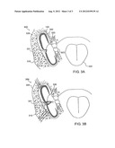 INTRA-ORAL SALIVA REMOVAL CONTINUOUS POSITIVE AIR PRESSURE DEVICE AND     METHOD diagram and image