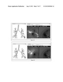 GLOBAL AND SEMI-GLOBAL REGISTRATION FOR IMAGE-BASED BRONCHOSCOPY GUIDANCE diagram and image