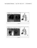 GLOBAL AND SEMI-GLOBAL REGISTRATION FOR IMAGE-BASED BRONCHOSCOPY GUIDANCE diagram and image