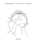 Extracranial Monitoring of Brain Activity diagram and image