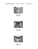 FLEXIBLE MICRODRILLING INSTRUMENTATION, KITS AND METHODS diagram and image