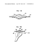 FEMORAL PROSTHETIC IMPLANT diagram and image