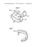 FEMORAL PROSTHETIC IMPLANT diagram and image