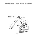 FEMORAL PROSTHETIC IMPLANT diagram and image