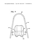 FEMORAL PROSTHETIC IMPLANT diagram and image