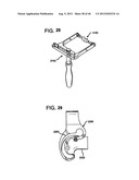 FEMORAL PROSTHETIC IMPLANT diagram and image