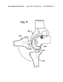 FEMORAL PROSTHETIC IMPLANT diagram and image