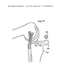 FEMORAL PROSTHETIC IMPLANT diagram and image