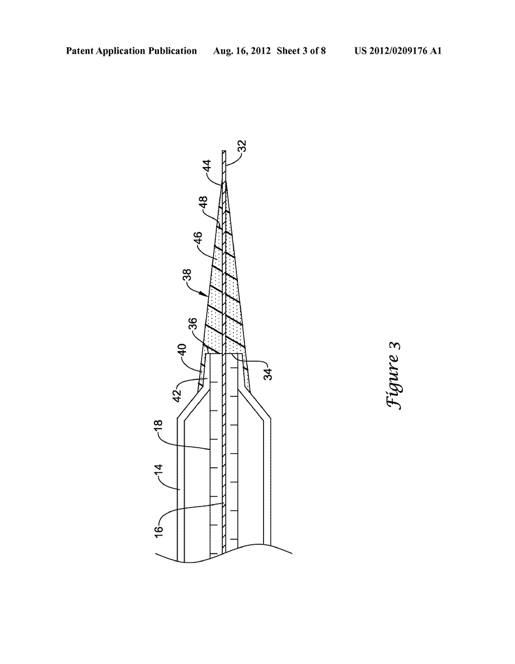 BALLOON CATHETER - diagram, schematic, and image 04