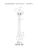 Support Instrument with Modular Intramedullary Nail diagram and image