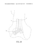 Support Instrument with Modular Intramedullary Nail diagram and image