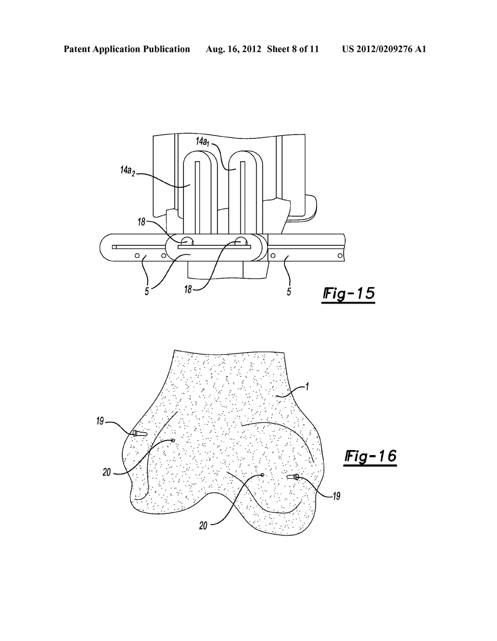 DEVICE FOR THE RESECTION OF BONES, METHOD FOR PRODUCING SUCH A DEVICE,     ENDOPROSTHESIS SUITED FOR THIS PURPOSE AND METHOD FOR PRODUCING SUCH AN     ENDOPROSTHESIS - diagram, schematic, and image 09