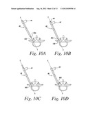 RIGIDLY GUIDED IMPLANT PLACEMENT diagram and image