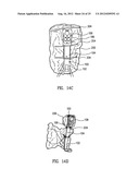 Telescoping Insertion Axis of a Robotic Surgical System diagram and image