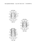 Spinal Stabilization Device diagram and image