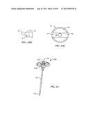 Spinal Stabilization Device diagram and image