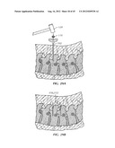 Spinal Stabilization Device diagram and image