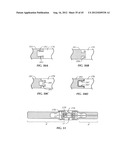 Spinal Stabilization Device diagram and image