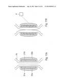 METHOD FOR THE TREATMENT OF GALLSTONES diagram and image