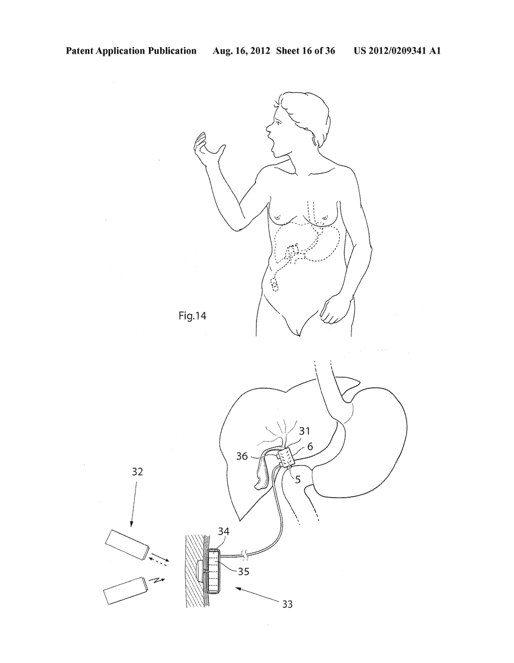 METHOD FOR THE TREATMENT OF GALLSTONES - diagram, schematic, and image 17
