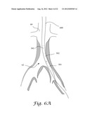 FENESTRATED ENDOGRAFT diagram and image