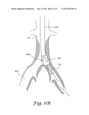 FENESTRATED ENDOGRAFT diagram and image