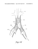 FENESTRATED ENDOGRAFT diagram and image