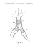FENESTRATED ENDOGRAFT diagram and image