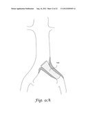 FENESTRATED ENDOGRAFT diagram and image