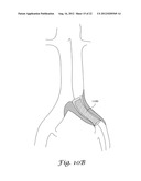 FENESTRATED ENDOGRAFT diagram and image