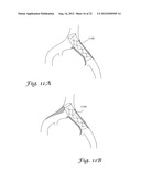 FENESTRATED ENDOGRAFT diagram and image